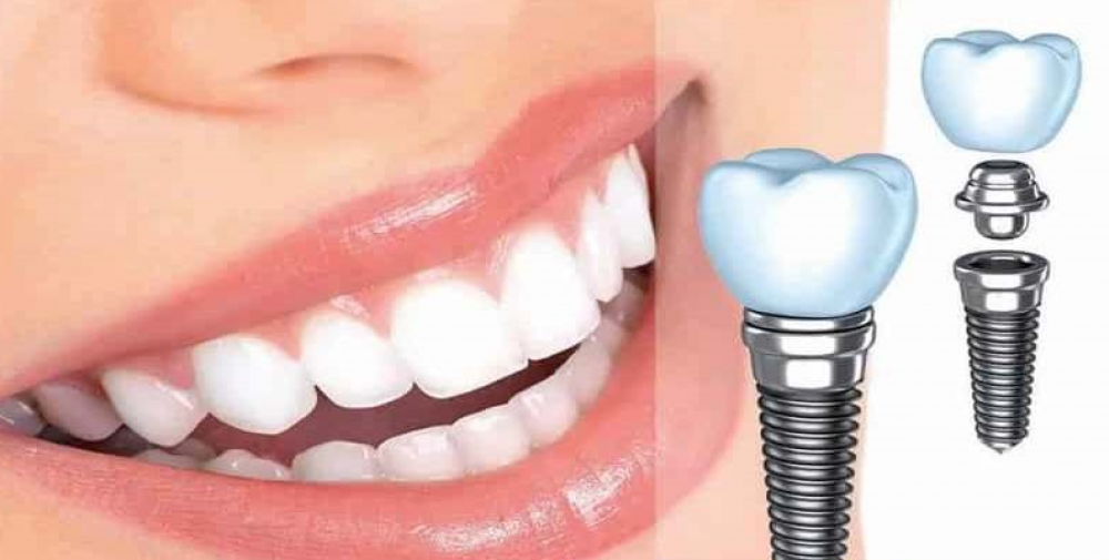 مزیت ایمپلنت دیجیتال